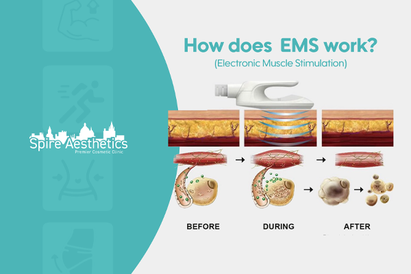 EMS treatment for post pregnancy weight loss treatment Liverpool