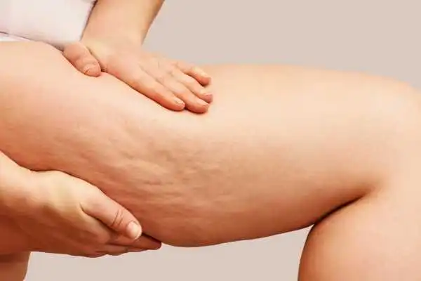 Image of woman showing leg with cellulite Liverpool