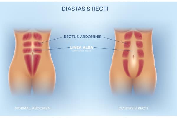 What Non-Surgical Options Are Available for Diastasis Recti Liverpool?