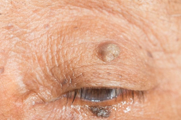 Skin imperfections Liverpool - Cryopen is fast and effective book in today!
