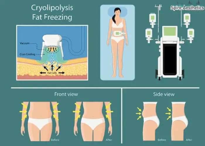 Fat freezing treatment Liverpool benefits for competitions to remove stubborn fat deposits.