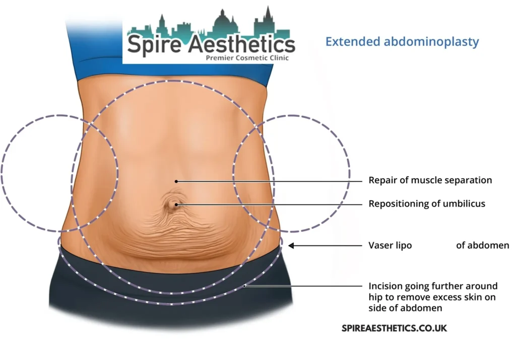 Understanding Loose Skin After Gastric Band Liverpool Surgery and HIFU Treatment