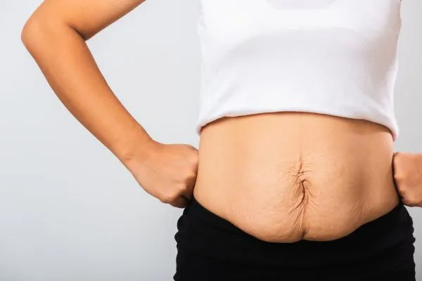 Image of a woman's stomach after weight loss with sagging skin following a gastric band Liverpool