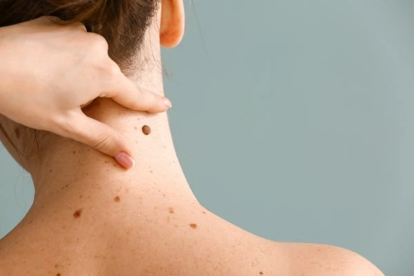 skin blemish removal Liverpool treatment