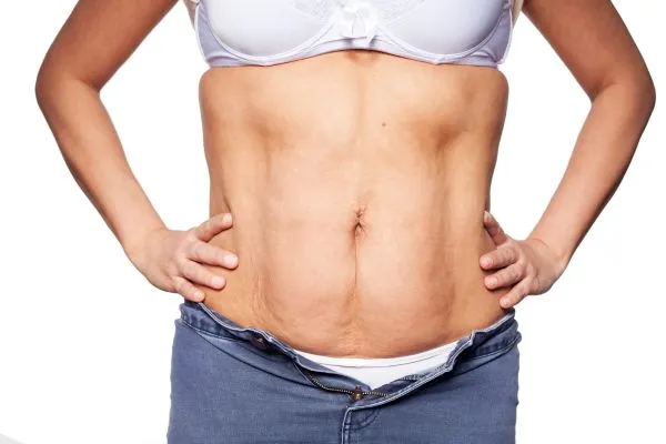 sagging skin on woman's stomach after weight loss injections Liverpool