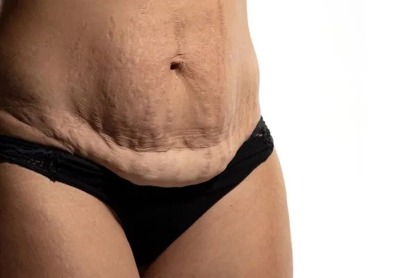 Image of womans stomach after weight loss injections Liverpool showing saggy skin