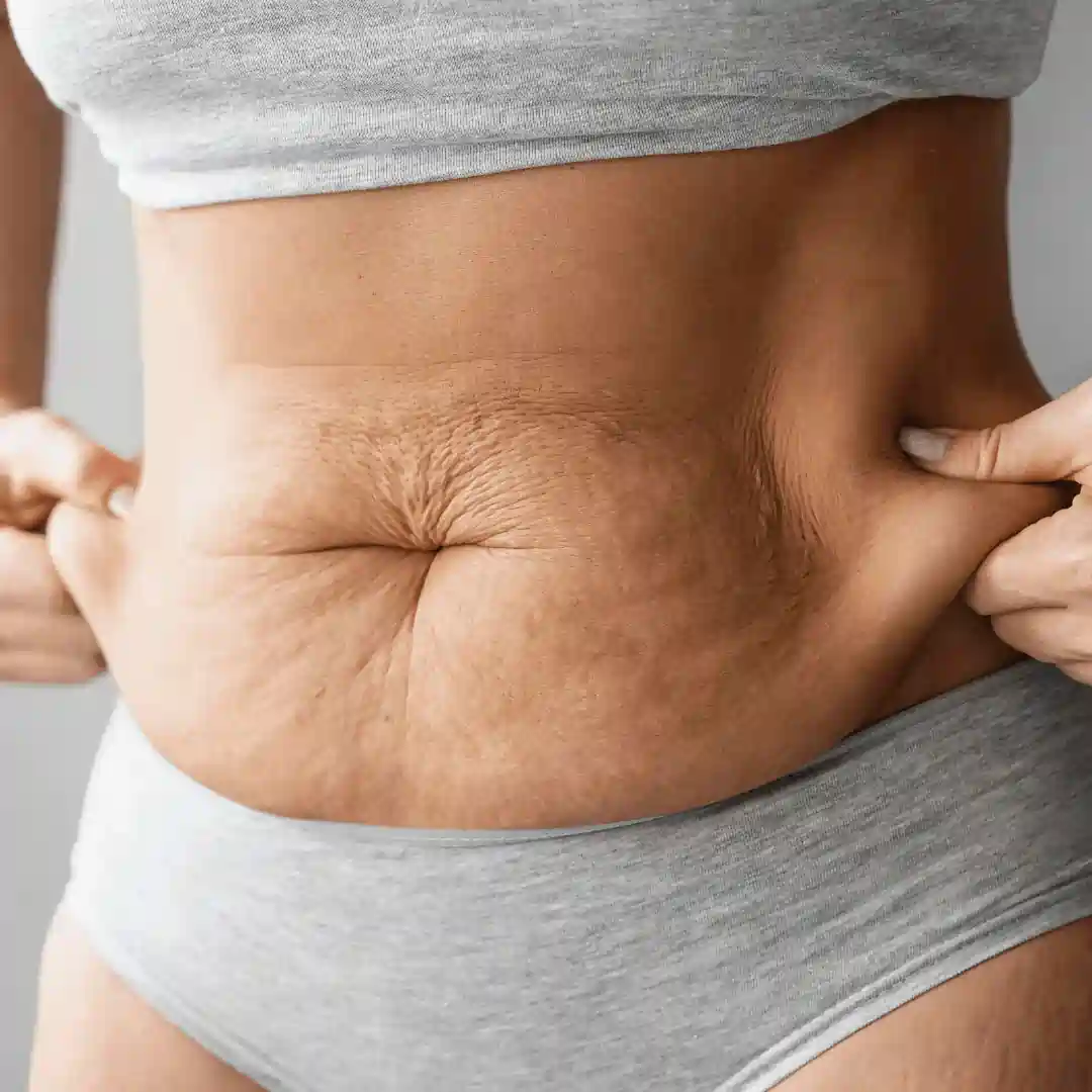 Is It Normal to Have Loose Skin After Pregnancy Liverpool?
