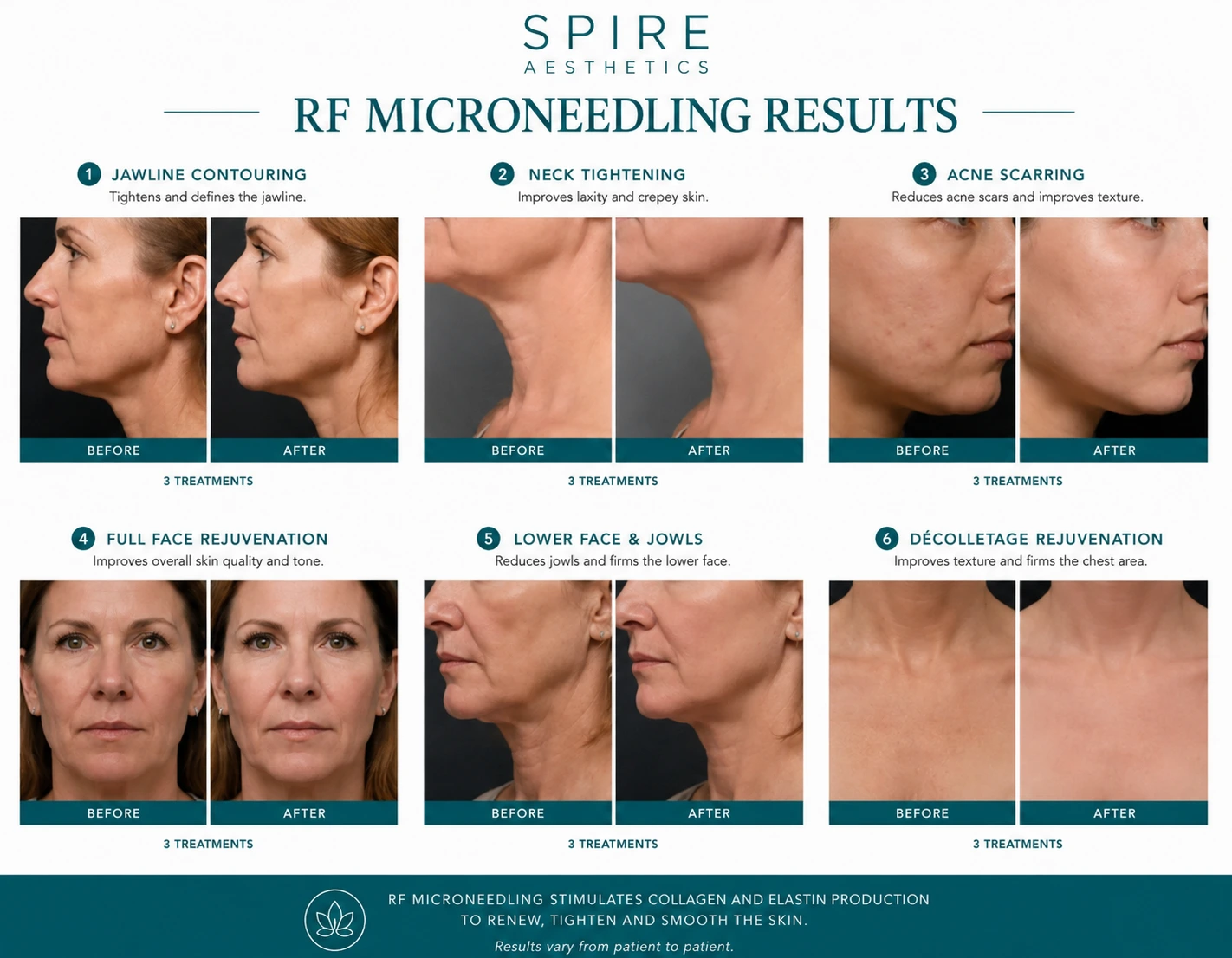 RF Microneedling Skin tightening Liverpool results