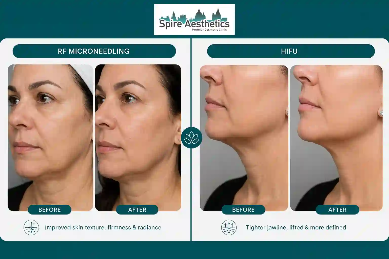 Can RF Microneedling and HIFU Be Combined Liverpool?
