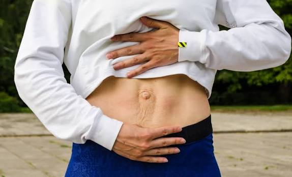 When Could Diastasis Recti Be the Missing Piece of the Puzzle Liverpool?