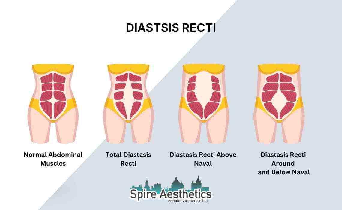Is Non-Surgical Diastasis Recti Treatment Right for You? Common Concerns Answered Liverpool